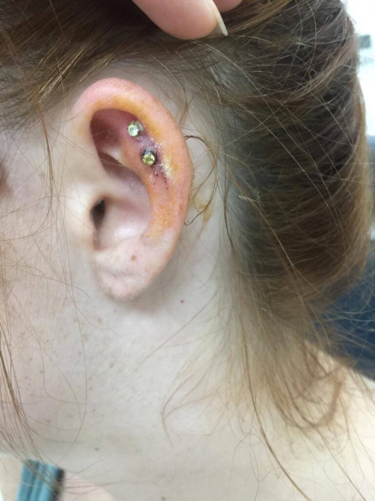 travel story, Travel Story: That One Time I Had Surgery in Vietnam on my Ear