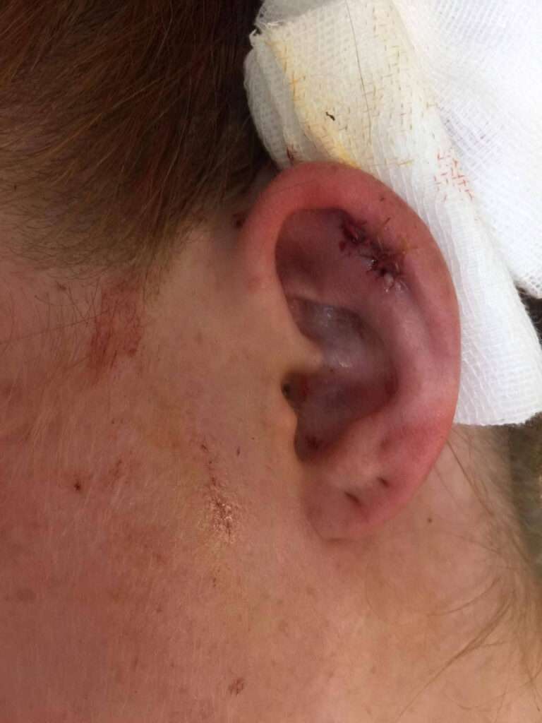 Ear surgery, Travel Story: That One Time I Had Surgery in Vietnam on my Ear
